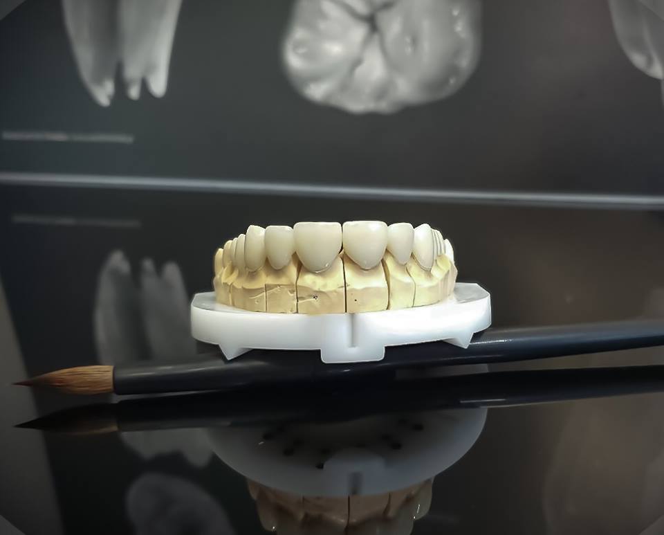 Виготовлення коронки